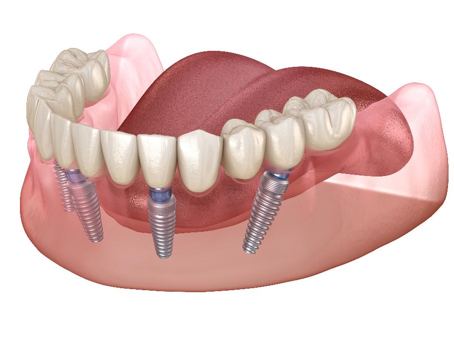 3D rendering of all-on-4 implants | all on four implants copley