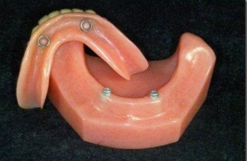 close up of denture | dentures medina