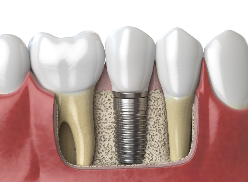 3D rendering of one dental implant | multiple tooth implants medina