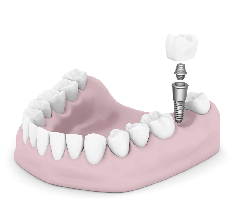 3D rendering of dental implants | dental implants near me