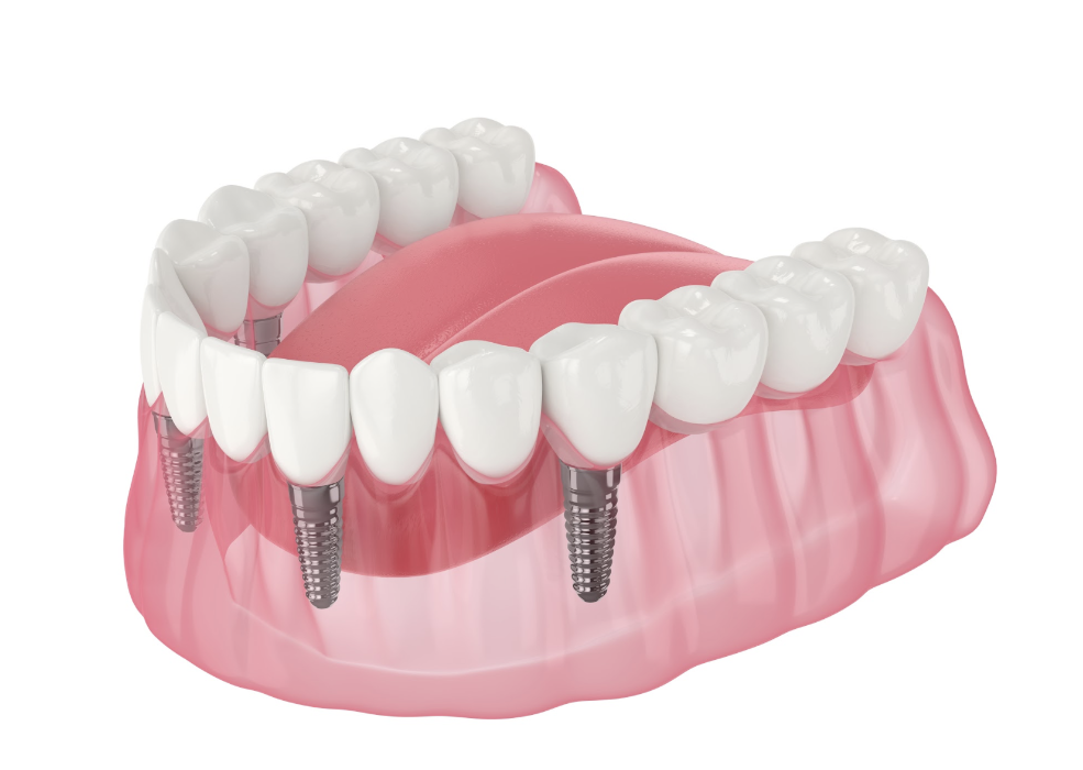 3D Rendering of multiple tooth implants | dental implants near me