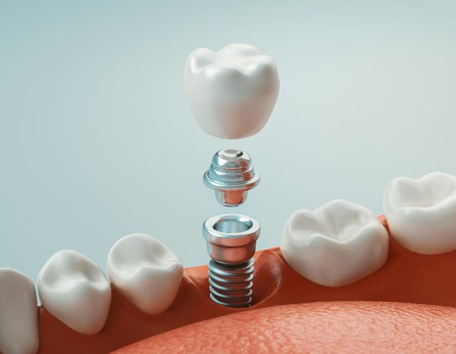 close up of dental implant 3 parts | dental implants near me