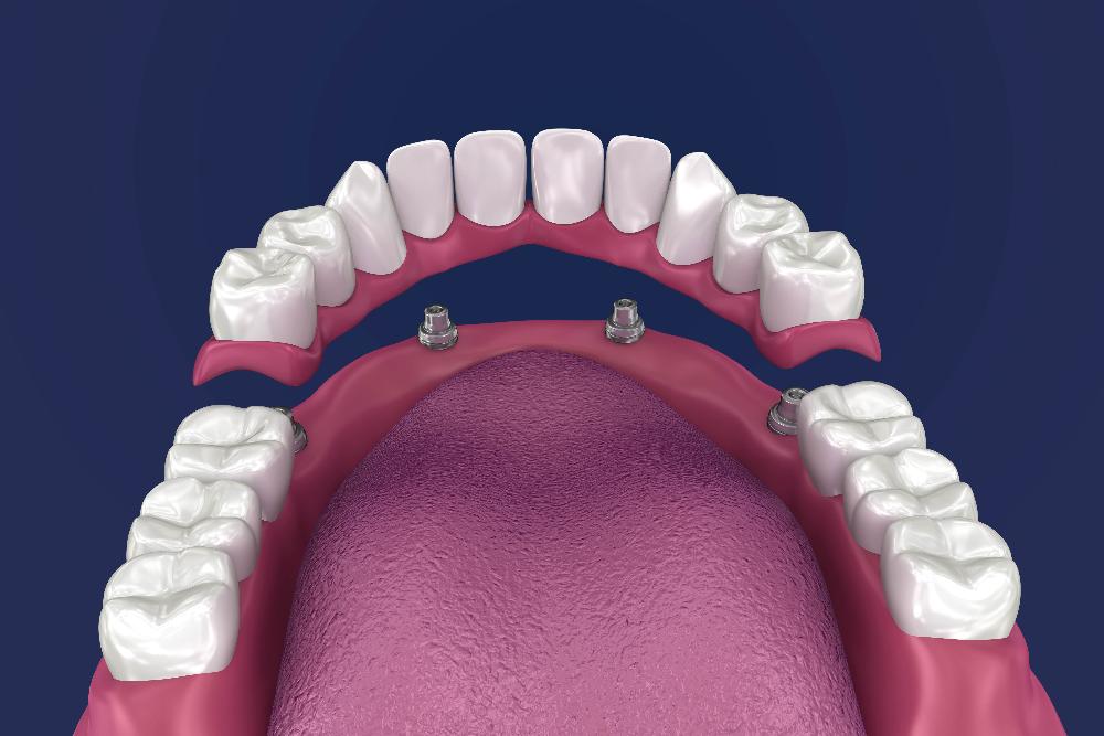 3D rendering of implant denture | implant dentures medina