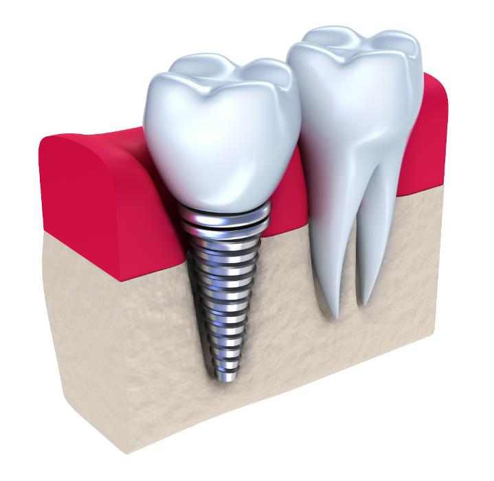 illustration of dental implant | delta dental dental implants