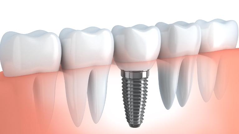 Dental Implants Diagram | Medina OH