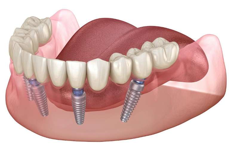 3D rendering of dental bridge | dental implants medina oh