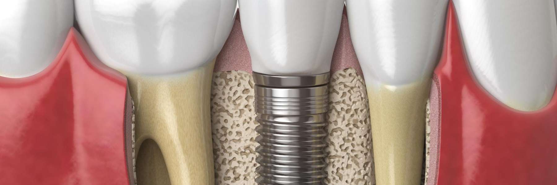 close up of tooth in jaw | dental implants near me