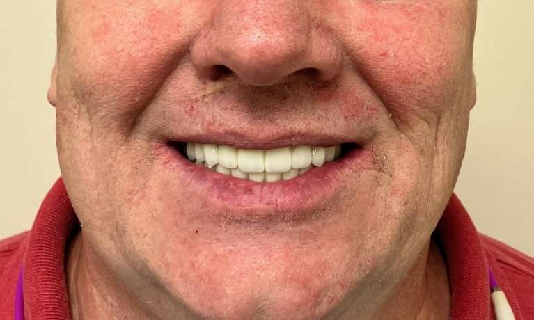 All-on-4-Implant-Results-After-Image