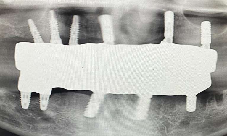 All-on-4-Implant-Results-Before-Image